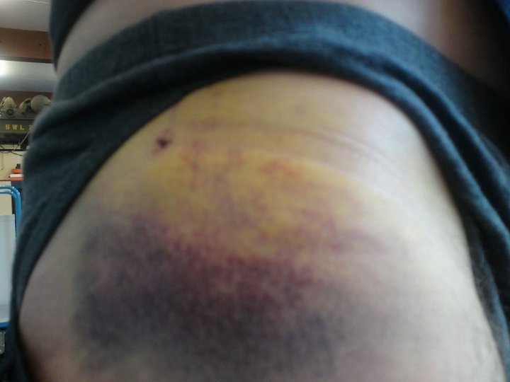 My bruise after Caersws bit me.