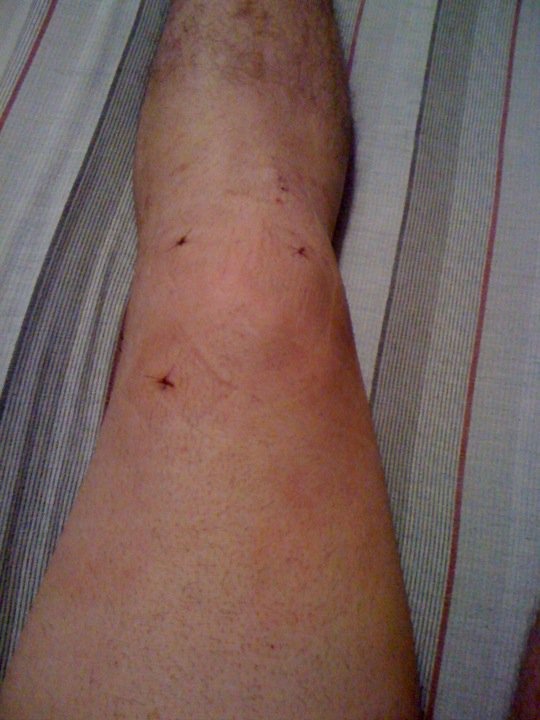 my leg 2 weeks after surgery