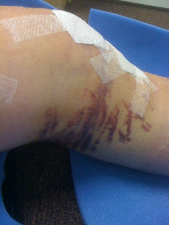 the wicked bruising from knee surgery