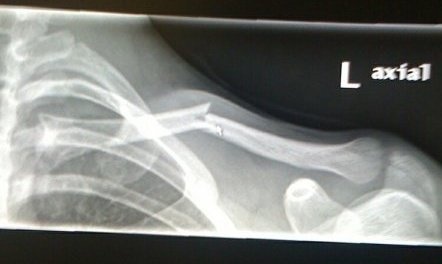 this is my x-ray of when i broke my collar bone the first time last season
