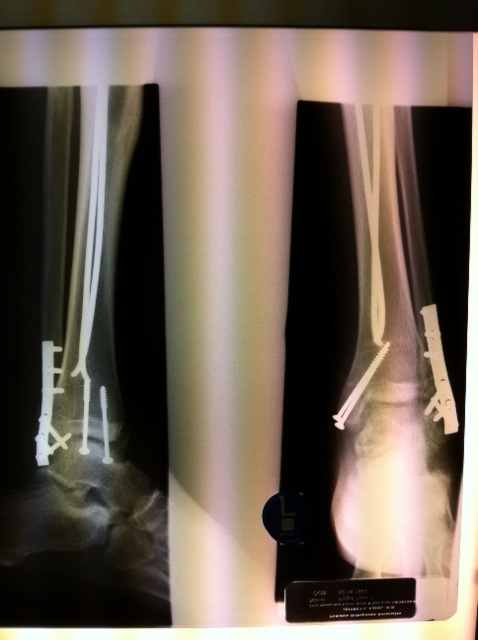 got my cast off today. heres an xray...straight up screws in my foot!