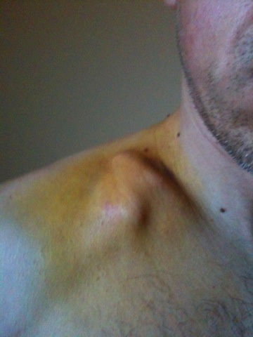 Ouch. Knockma hill takes its next victim, my poor old collar bone gone again for the forth time. Will I ever learn. Think I'm number three now to get destroyed on that hill! BEWARE.