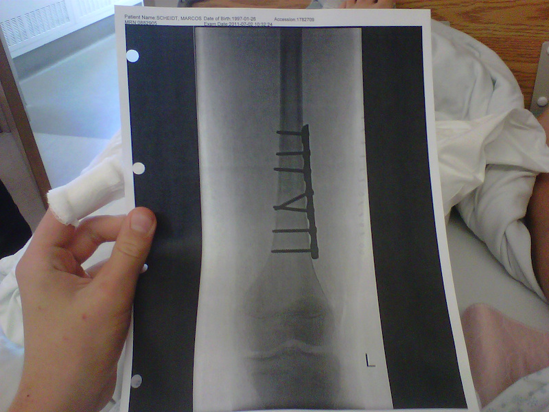 broken femur recovery