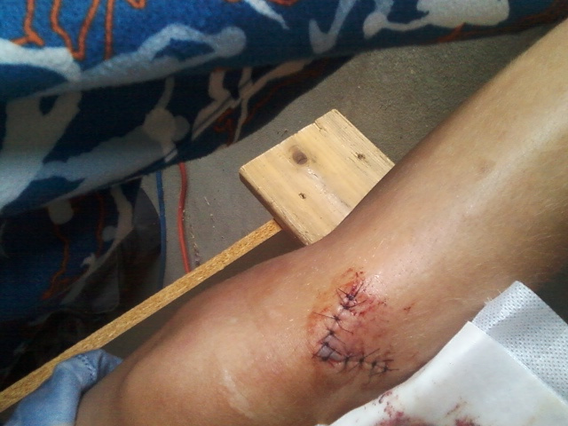 me after the stiches :)