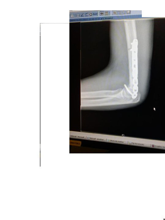 broken arm after just flipping a manual on a bmx 2 plates 6 screws