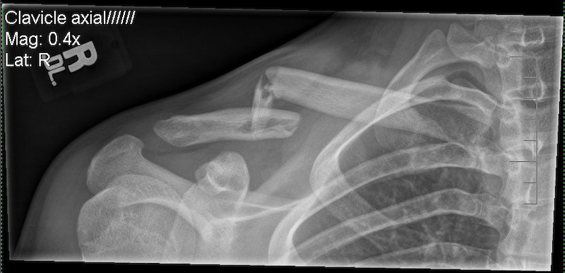 Broken Collar Bone Recovery Time - Page 24 - Pinkbike Forum