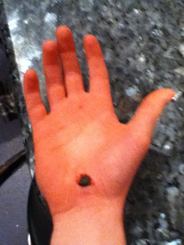 Came off my bmx and got a stone embedded in my hand.