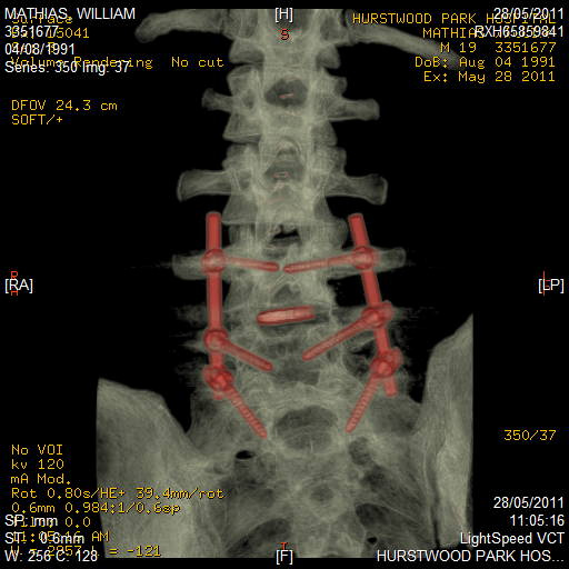 How it sits in/on my spine.

Looking from the front again.

Been told I may not be able to mountain bike again...