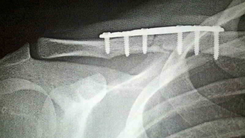 6 skrews and a plate , this is what they do when u break ur collar bone realllll bad