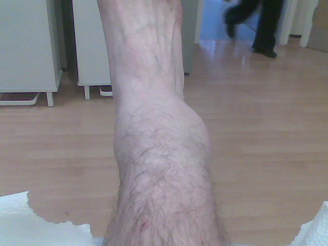 Taken on my crappy phone, busted my ankle big and couldn't walk for several months. Went for physio and its still not right. Got cellulitis (bacterial infection) and nearly got blood poisoning... just from a sprained ankle, how crazy.

And my lower leg isnt that thick, the swelling travelled up my leg to my knee.