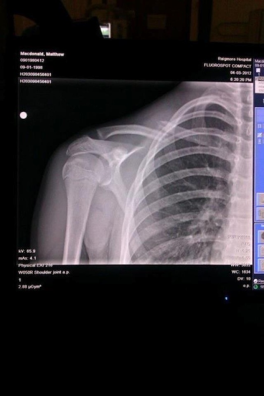 Broke my collar bone whilst riding Downhill, hopefully will be back for Pitfichie SDA