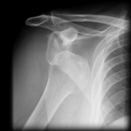 Dislocated Shoulder:
        Chain popped going roughly 30mph, feet slipped, I avoided pavement by swirving into a yard where I flew over the handlebars and landed with a bike on top of me. Road home, drove to hospital.
