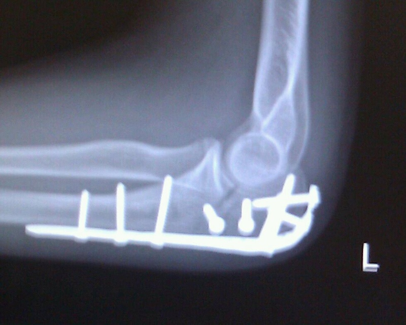Broken elbow