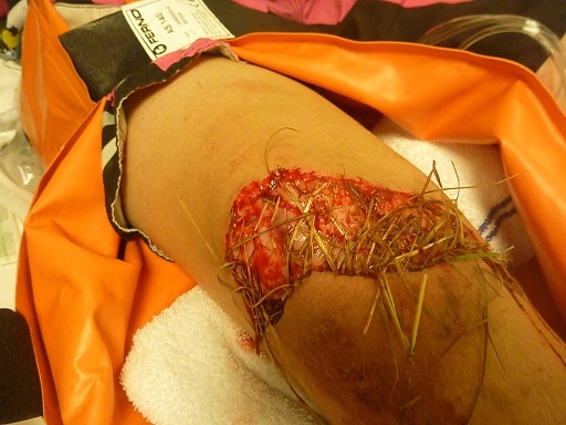 me knee after crashing while training for the 2010 QLD state champs