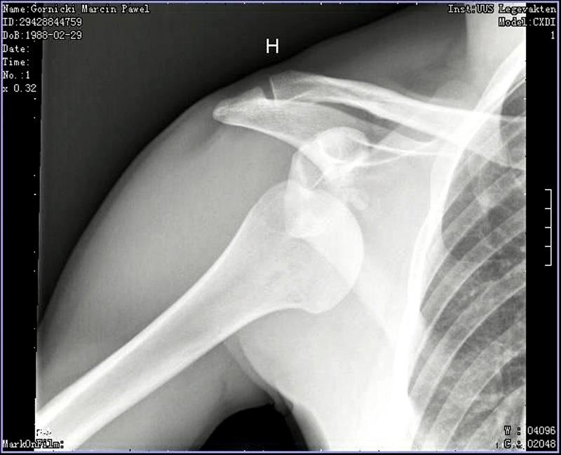 First days after three years break... Now I have dislocated shoulder after one track in Holmenkollen (Norway/Oslo)