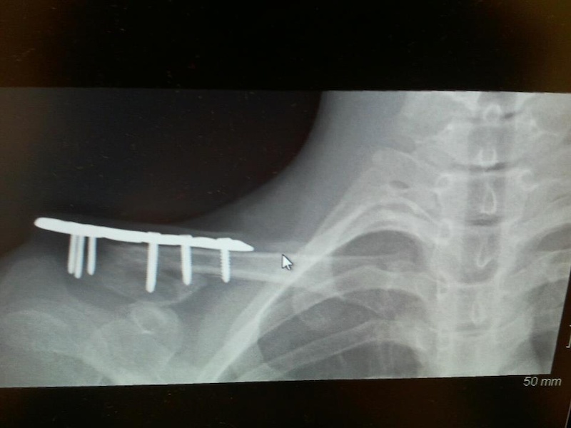 6 stainless steel screws, and that metal plate poking out of my shoulder. Plus some miscellaneous spine and rib bones.