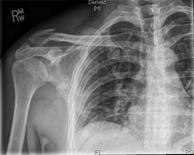 fractured clavicle, scapula and 7 ribs