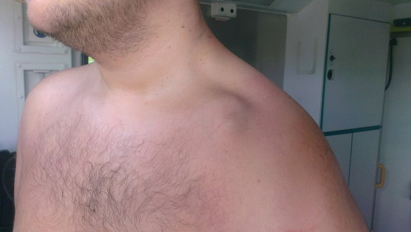 broken-collarbone-help-page-2-pinkbike-forum