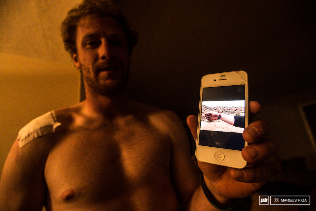 Mike Hopkins showing me a picture of his wrist after crashing off the steep chute at the top of his run. Get well soon bro.
