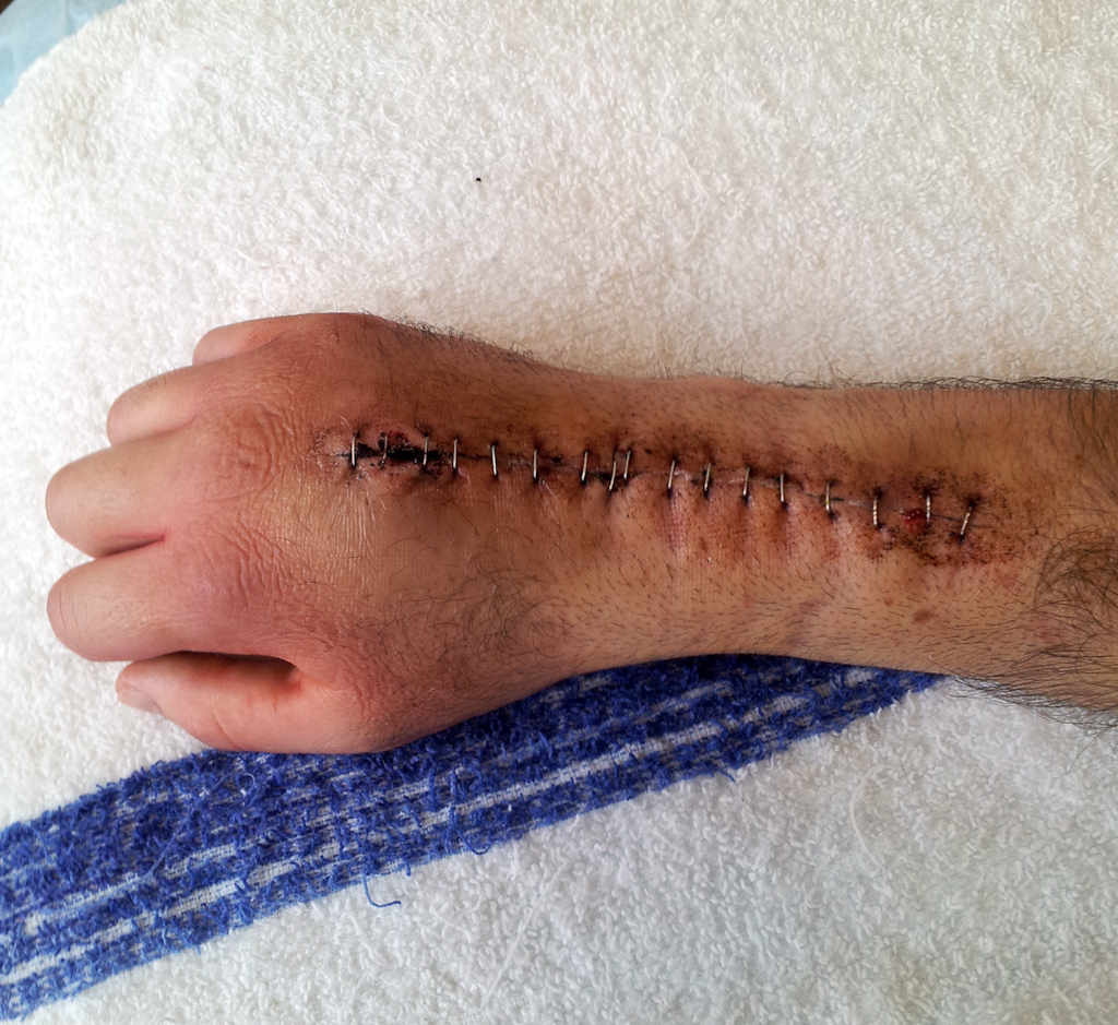 The aftermath of wrist surgery number six... Now in healing mode.