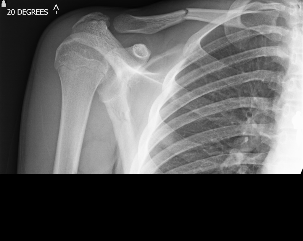 Broke my collar bone in an xc race, finished first.