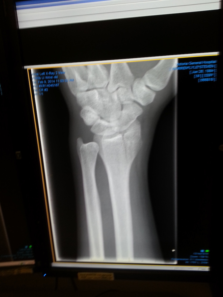 Broken wrist on the new step up. Heading for surgery for some pins!