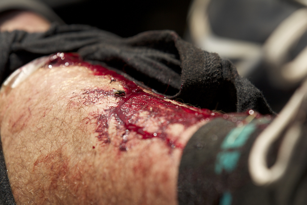 The puncture in Joey Schusler’s shin resulted in a ride to the hospital and 30 stitches.
