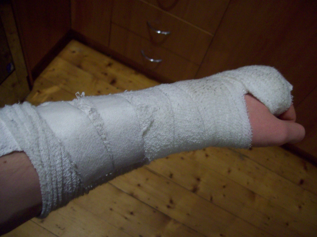Fractured wrist just in time for the annual cressy descent race. That basically sums up my luck...