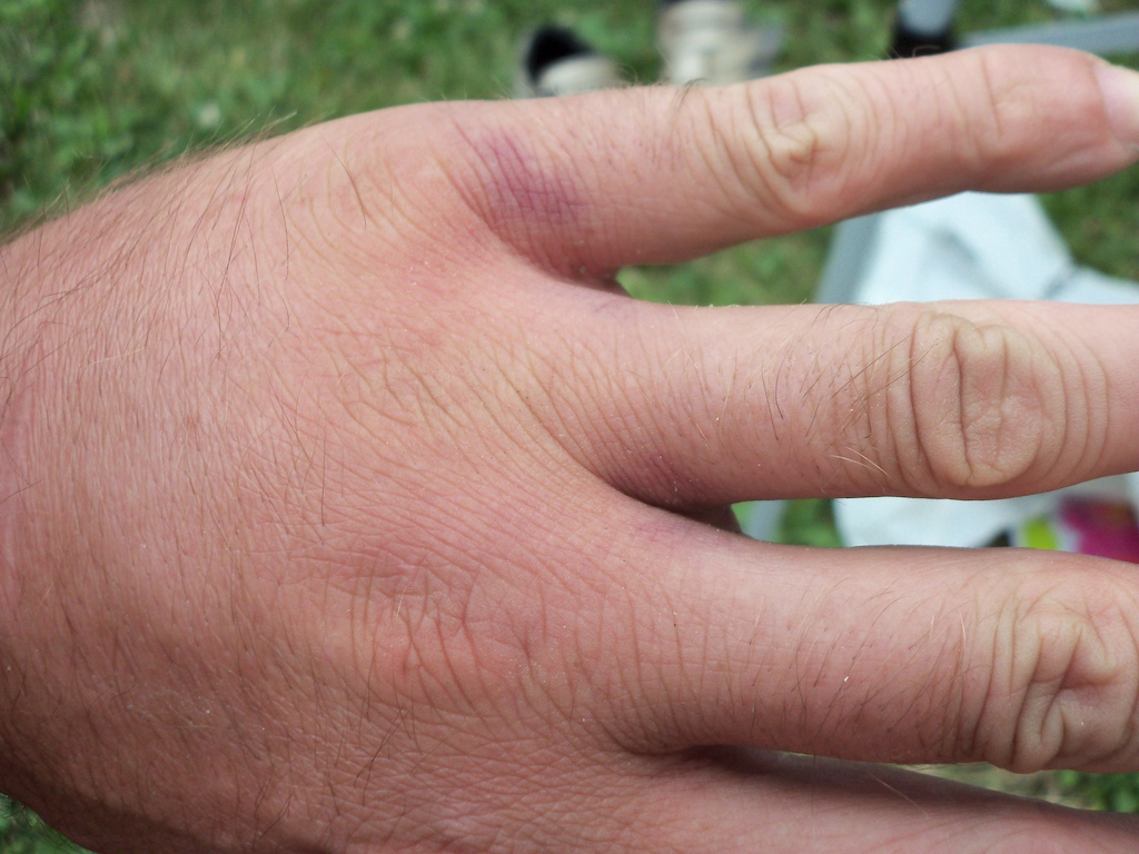 turns out it was a broken hand done on the first day of riding