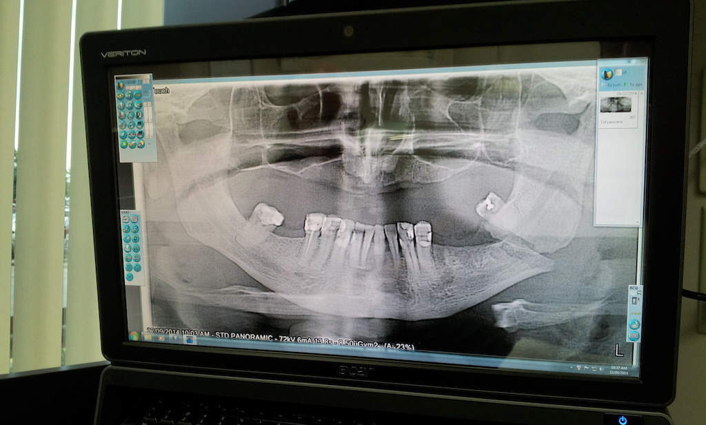 Busted jaw Sept 21, 2014.  2.5 hr surgery, 2 metal plates, 6 screws and some wire!  My best MTB crash to date!
