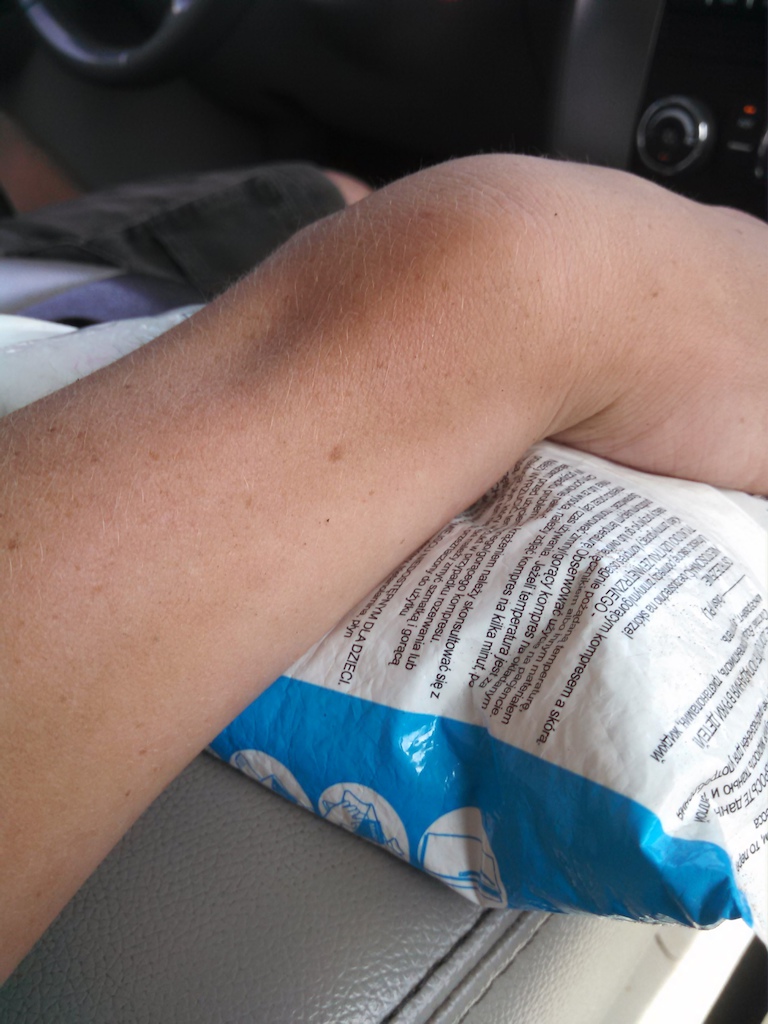 My broken wrist after going OTB at Woodward Tahoe.