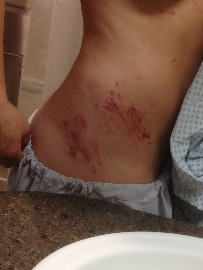 Injury Pics from the most recent mishap at Canyons Bike Park (Sept. 24, 2014).

Permanent scarring? Sweet!