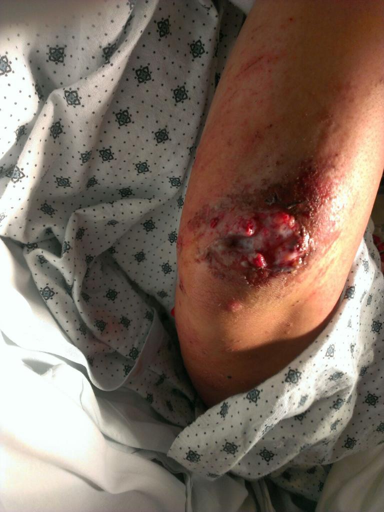 Injury Pics from the most recent mishap at Canyons Bike Park (Sept. 24, 2014).

Bones, fat, tissue. YUM!