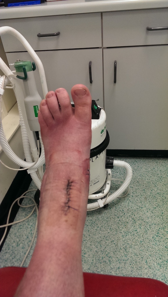 most recent operation which was on the 10th december 2014 and had to have a triple fusion of the ankle ! Hopefully be riding again by end of march !! xray pics to come !!