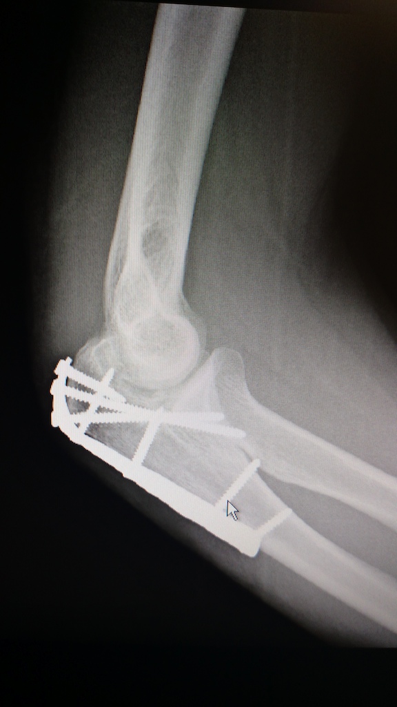 Broken olecranon aka elbow