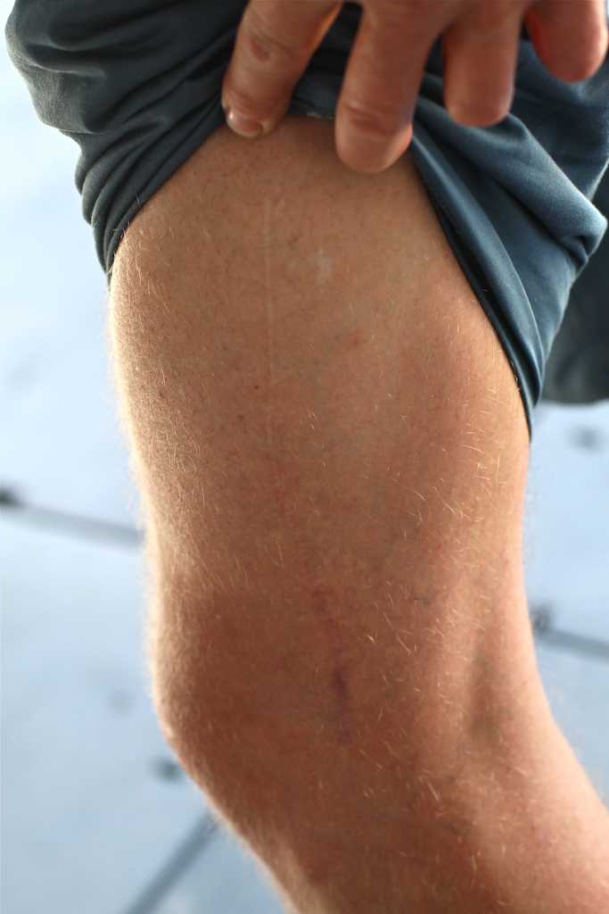 Chris Akrigg's leg