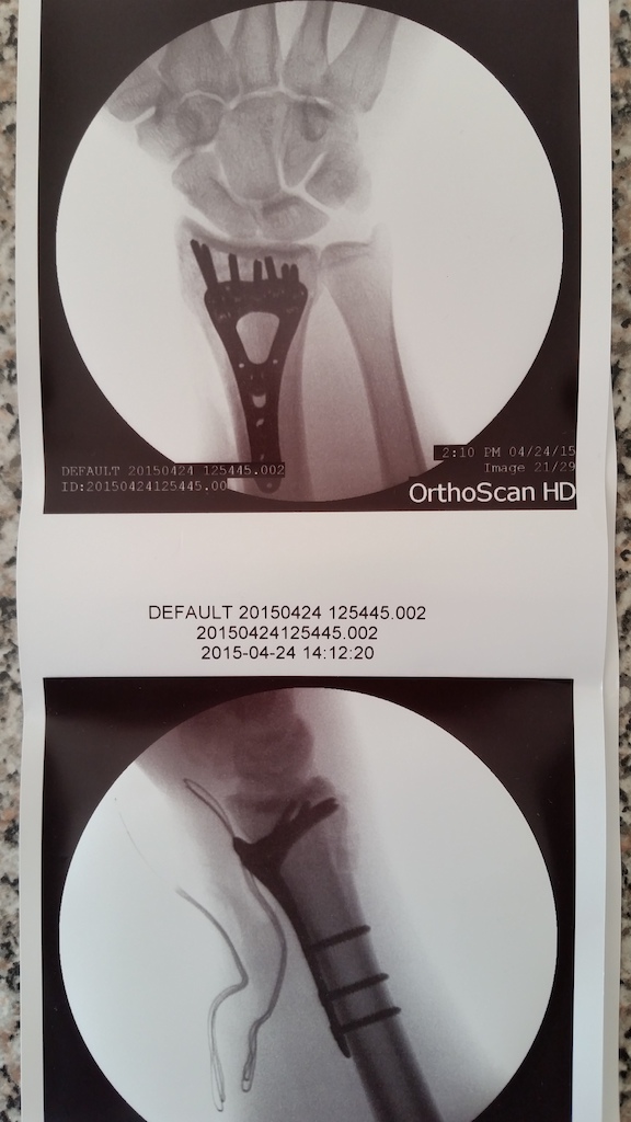 Post-op pics of my broken and displaced distal readius. Titanium to save weight! Haha!