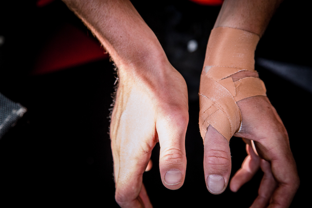 A first run crash has left Brendan with left thumb to match the right one he broke a few years ago.