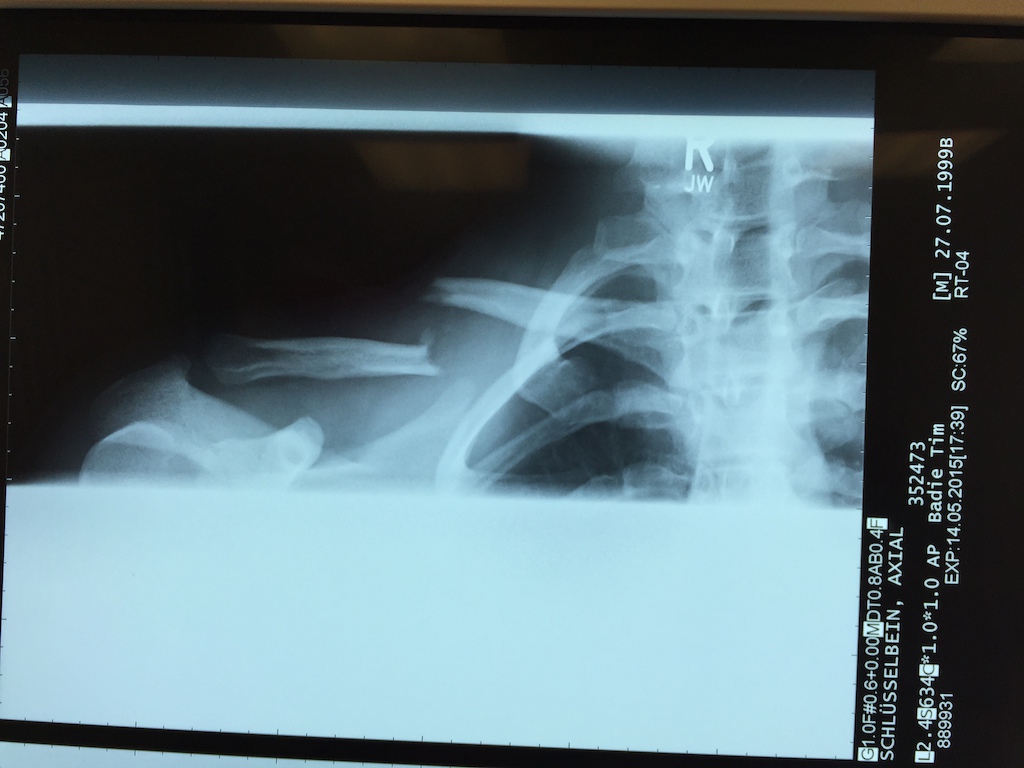 A radiograph picture of my broken Collarbone 2,5 Months ago.
