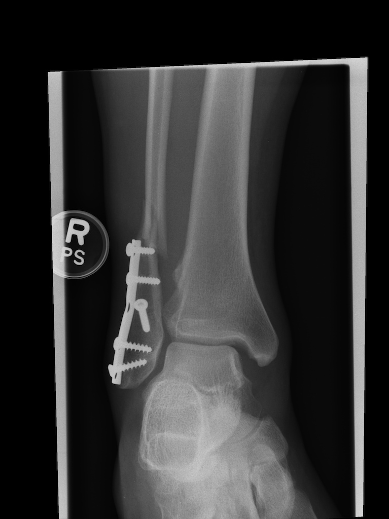 The old screws and plate - xray taken 2 hours after I crashed on Schleyer. You can see the fracture just above the top of the plate and the ankle has been displaced to one side.