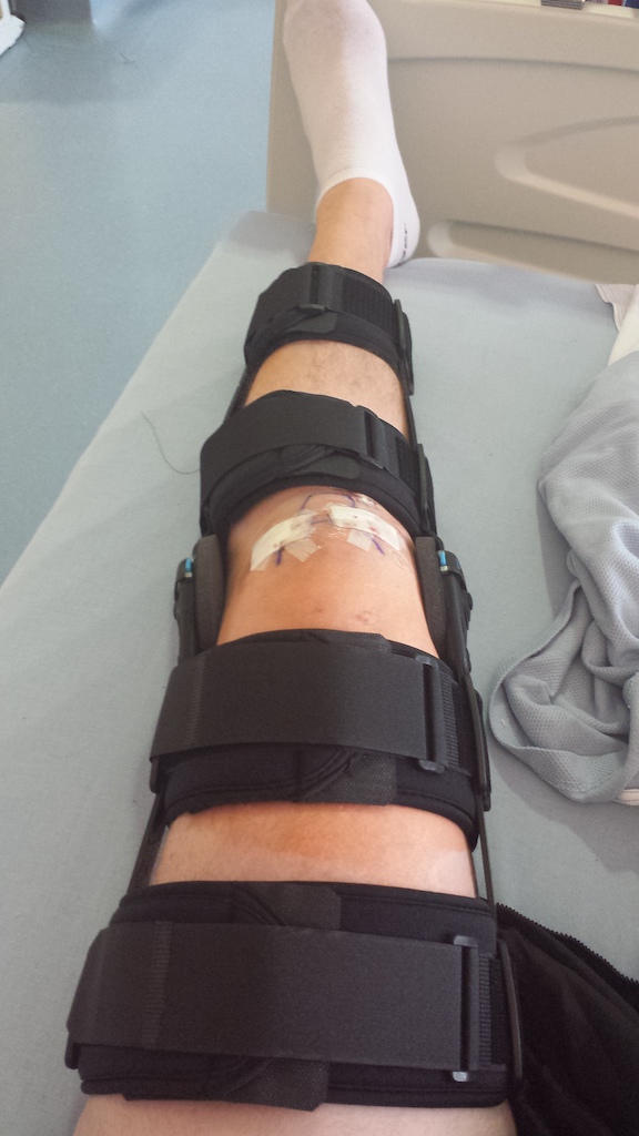 ACL Recon done, rehab to go