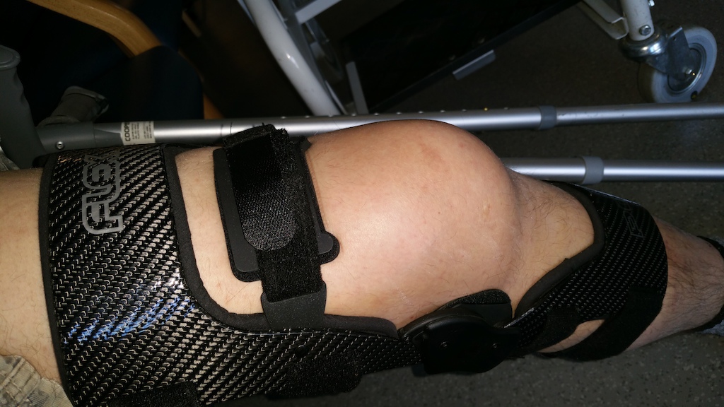 My shiny new carbon pcl brace!!  (With a hugely swollen knee in it)