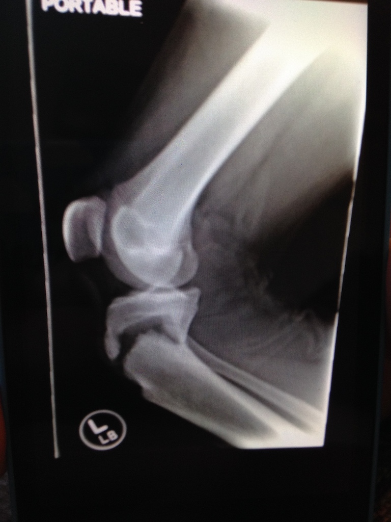 Oh the fun of looking at what u broke under your skin !!!! Tore the growth plate off my knee had three pins put in my knee during surgery