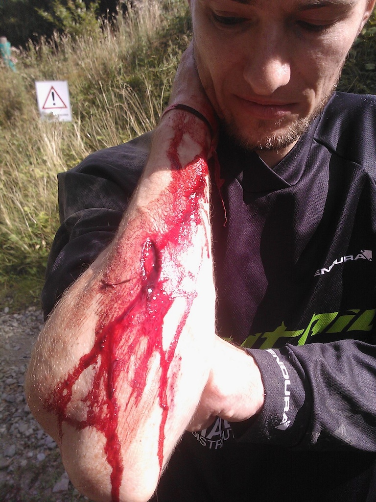 never, ever, underestimate the hidden power of sharp rocks! no hard crash, just lost the front wheel in a dusty corner and made a nice slide over 1 sharp edged rock. still super lucky it didn't cut anything major. ruïned a perfect day in willingen, lesson learned!