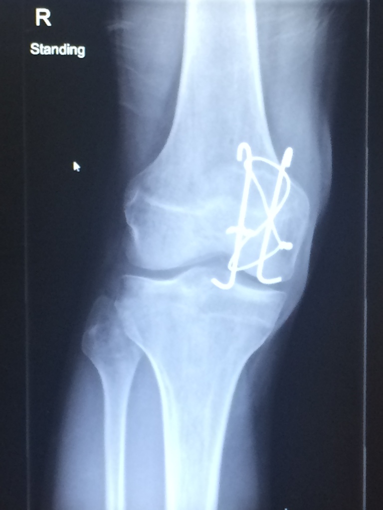 My x-ray twelve months after my accident :)