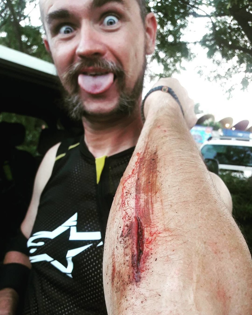 Had a high speed fall, bike is ok, everything ok, except that the elbow pad due to friction moved up and some sharp stone was happy to greet my soft skin... 6 stitches later I'm ok to continue shredding