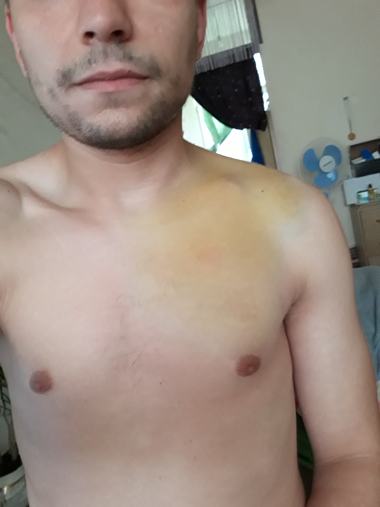 Collarbone break, freakish colours after a week