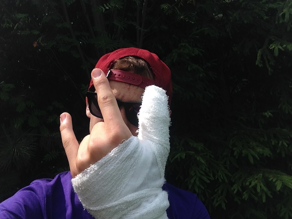 broken finger :v 
f*cked 3 weeks