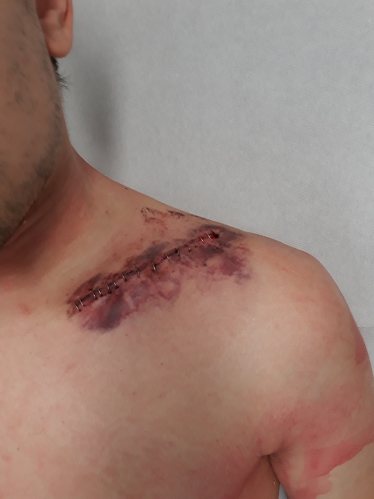 finally had my collarbone plated