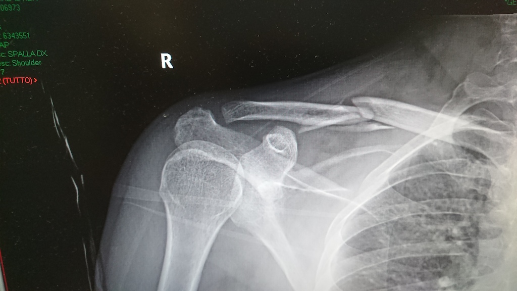 Broken Collar Bone Recovery Time - Page 74 - Pinkbike Forum